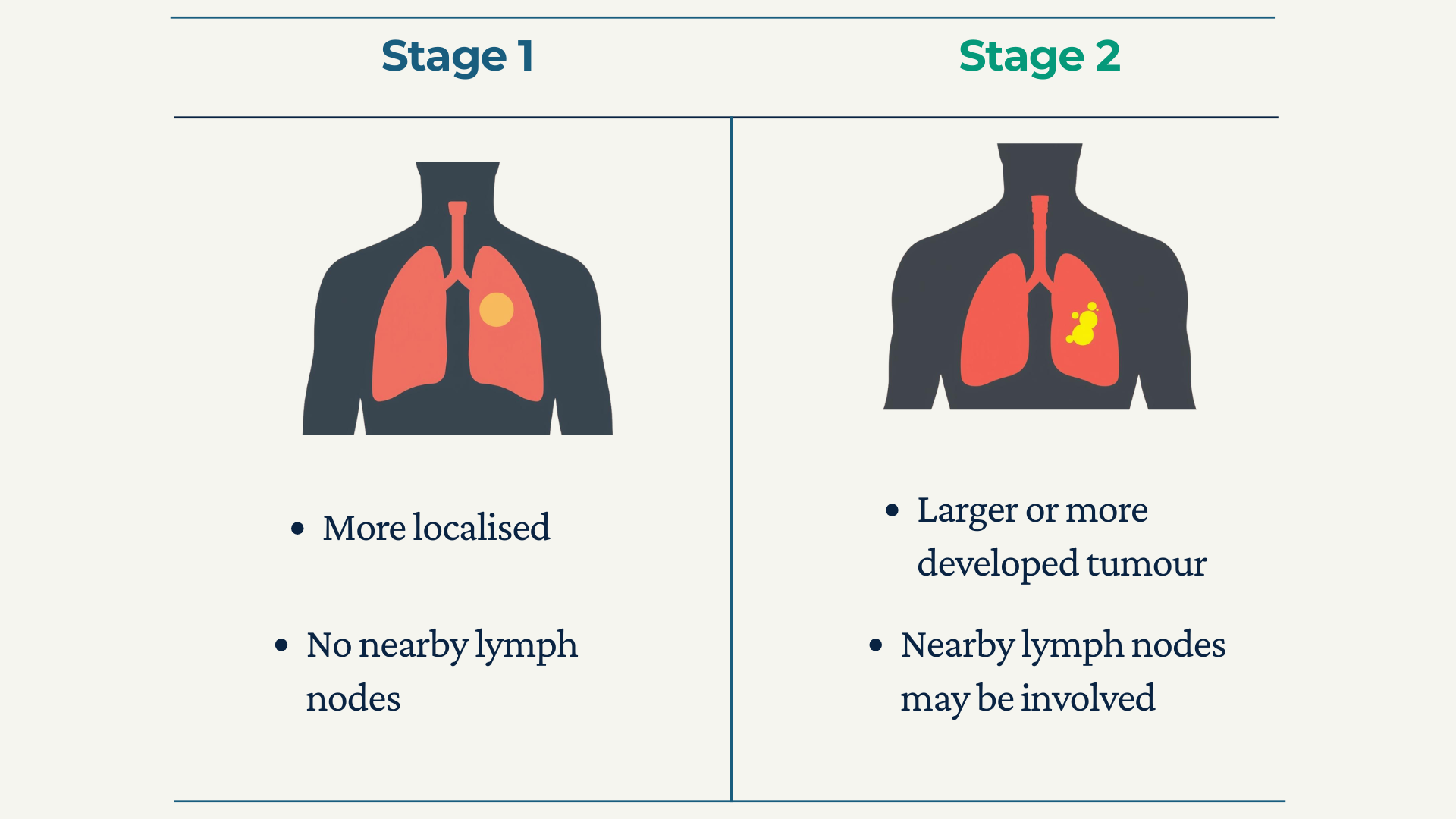 Infographic showing the key differences between stage 1 and stage 2 lung cancer in a simple visual comparison.